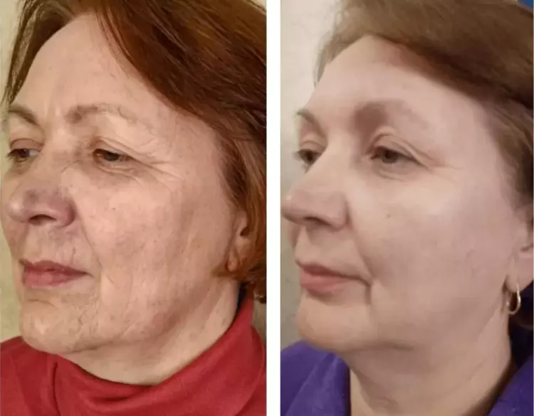 resultados rosa mosqueta amazonica